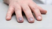 Understanding Blue Nail Beds (Cyanosis) at End of Life