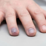 Understanding Blue Nail Beds (Cyanosis) in End-of-Life Care